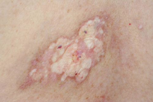 Lichen xơ hóa - Hình ảnh minh họa